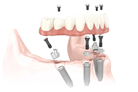 All On 4 Dental Implant Illustration