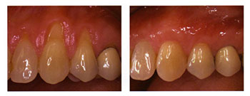 Soft tissue Grafting: Before / After