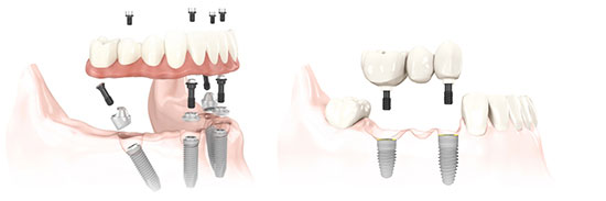 Illustration of All On 4 Implant Technique