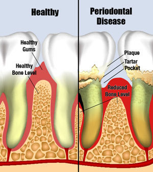 Healthy gums compared to periodontal disease