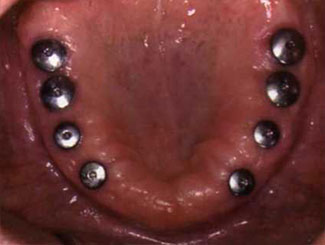 Screw Retained Dentures, Stage 2