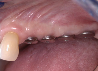 4 Single Implants, Stage 2