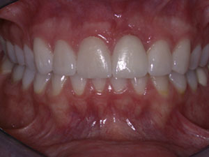 Single Dental Implant Case