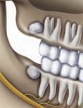 Wisdom tooth position at 12 years