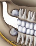 Wisdom tooth position at 14 years