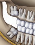 Wisdom tooth position at 17 years