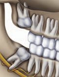 Wisdom tooth position at 25 years