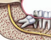 Wisdom tooth with crowding, damage