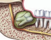 Wisdom tooth with a cyst