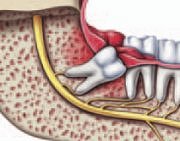 Wisdom tooth with infection